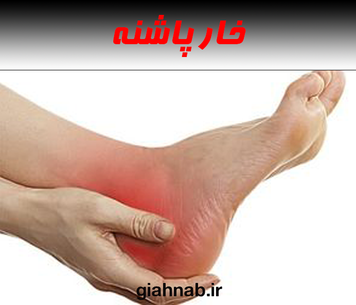 خار پاشنه